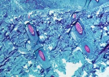 ১১ দেশে মাঙ্কিপক্স, বেশি রোগী জার্মানিতে